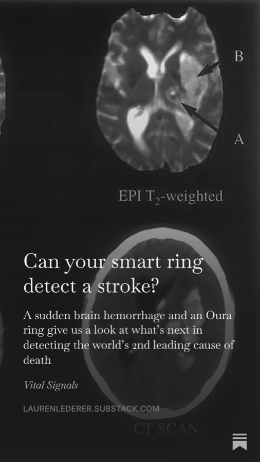 Brain MRI and CT scans behind the title Can your smart ring detect a stroke?